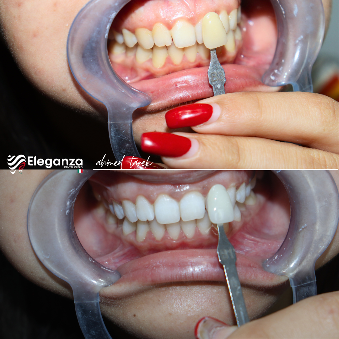 after and before teeth bleaching